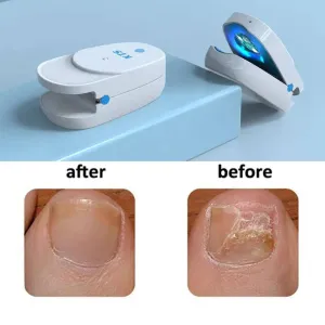 Nail Treatment Laser Device For NaiL. Removal Anti Infection Paronychia Ony chomycosis Care